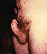 photo showing penile bend with peyronie's disease