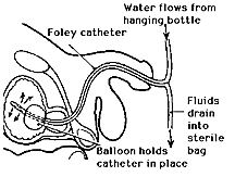  Foley catheter in place to drain urine.  