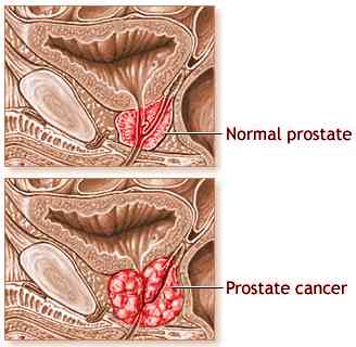 prostate-cancer_sam2.jpg(14450 bytes)